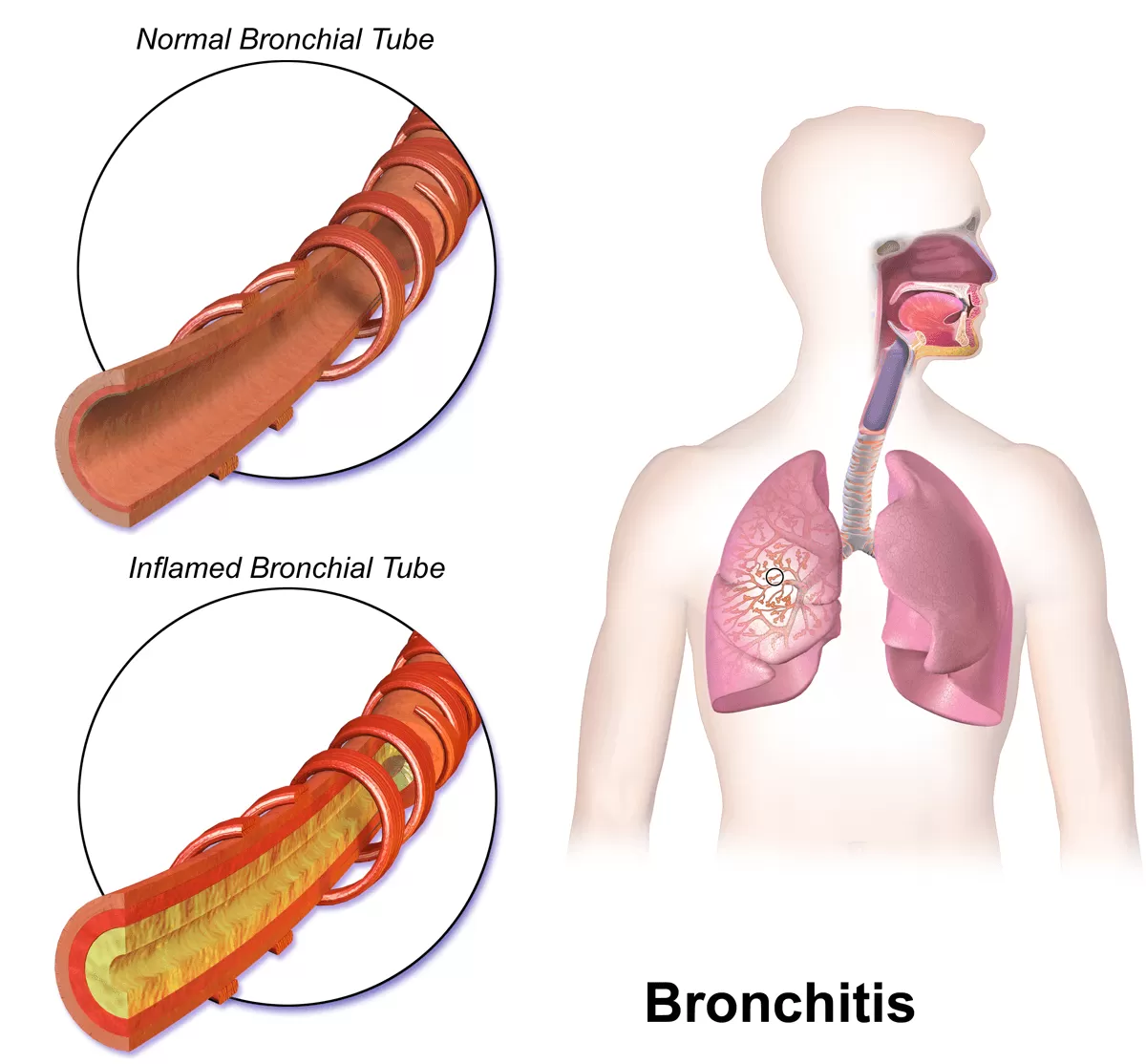Bronchitiss
