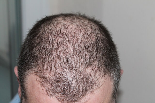 Stop Hair Loss Due To Creatine
